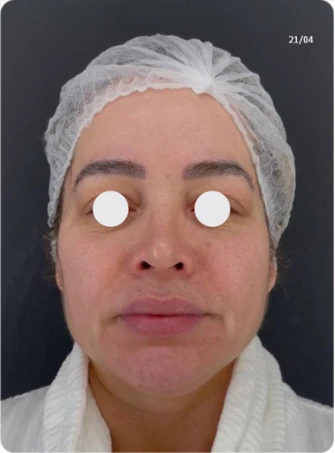 Antes: reposição volumétrica facial