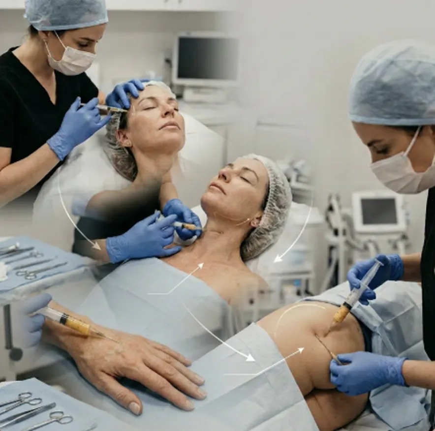 Etapas do fat grafting: coleta, processamento e aplicação da gordura autóloga