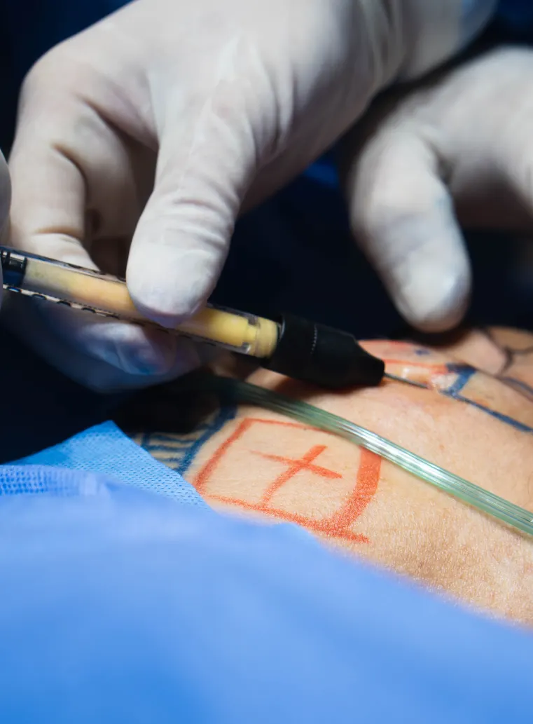 MICROFAT E NANOFAT