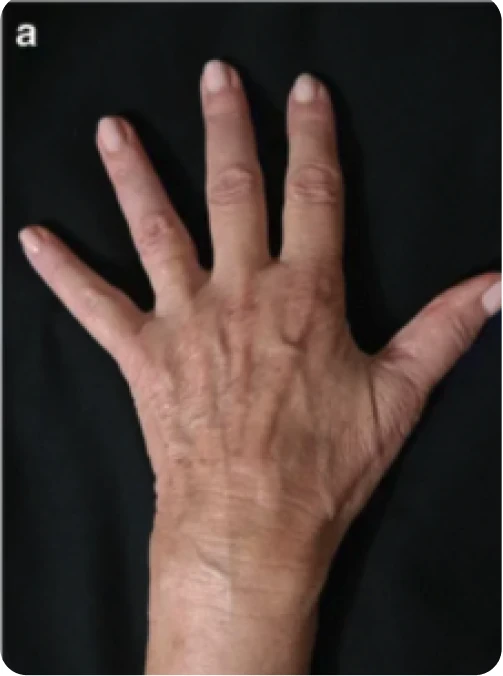 Antes: rejuvenescimento das mãos