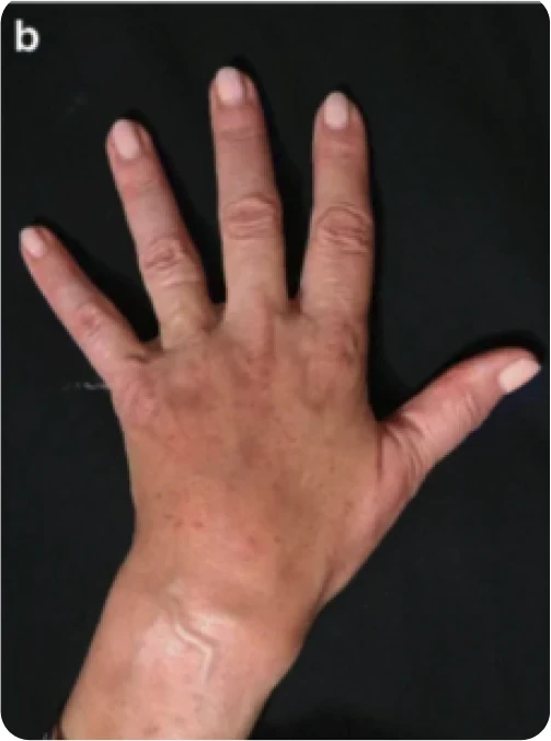 Depois: rejuvenescimento das mãos