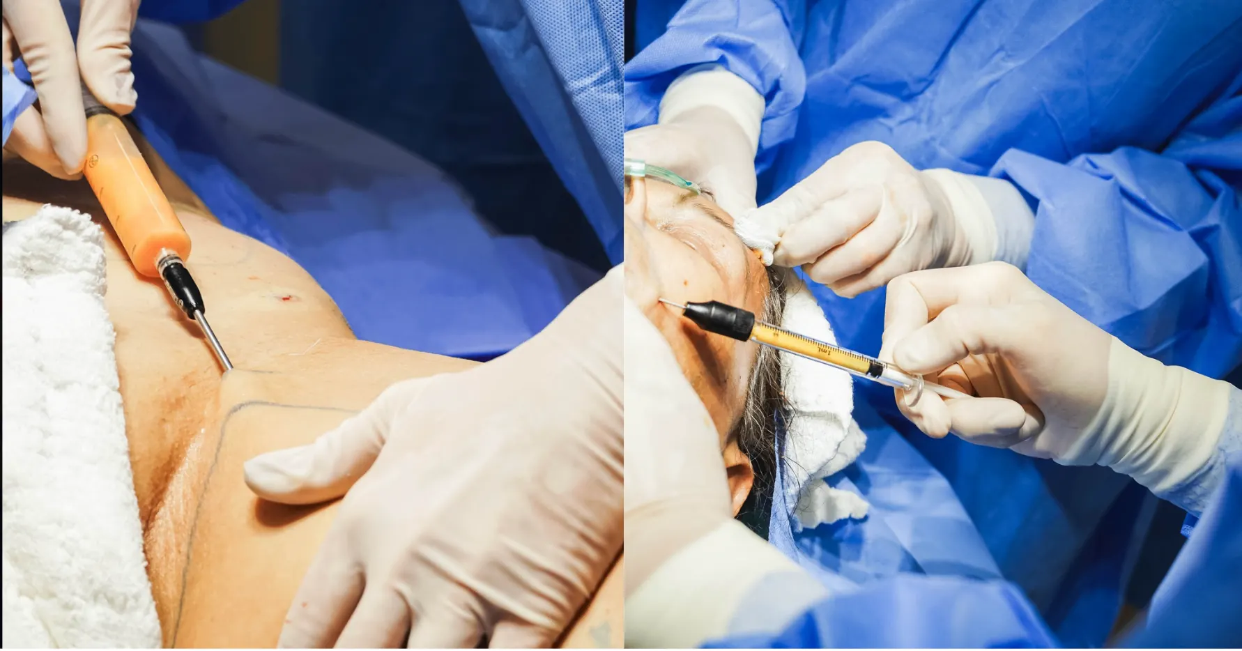 Coleta de gordura no abdômen e aplicação facial de gordura autóloga em ambiente cirúrgico