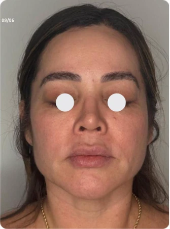 Depois: reposição volumétrica facial